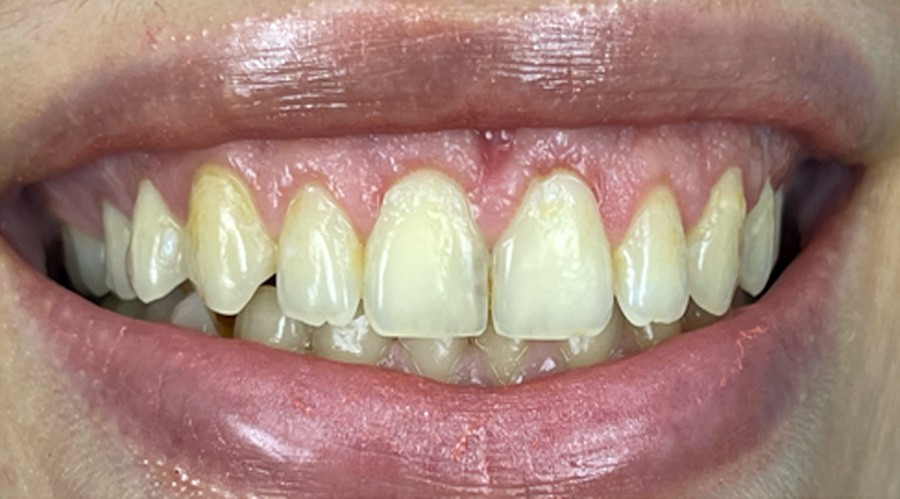 بعد تجميل وعلاج اللثة مركز دكتور ايمن الغمراوى لطب الاسنان 8